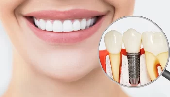 Dental Implants Help Replace Missing Teeth: Why Display a Toothless Grin?