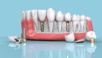 Factors To Be Considered Before Getting A Dental Implant