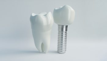 The Dental Implants And Your Dental Health