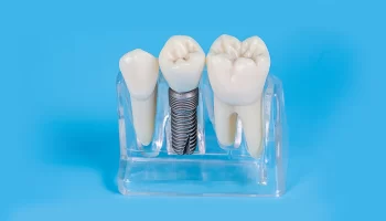Dental Implant Placement Surgery with the Benefits and Risks