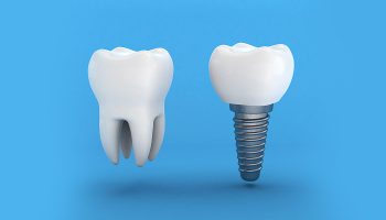 How Long Does Dental Implant Surgery Take?