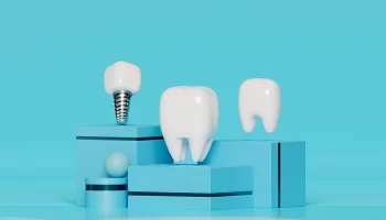 How Long Does Dental Implant Surgery Take?