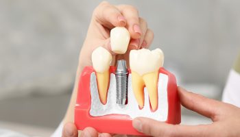 Bone Grafting for Dental Implants: Purpose and Procedure