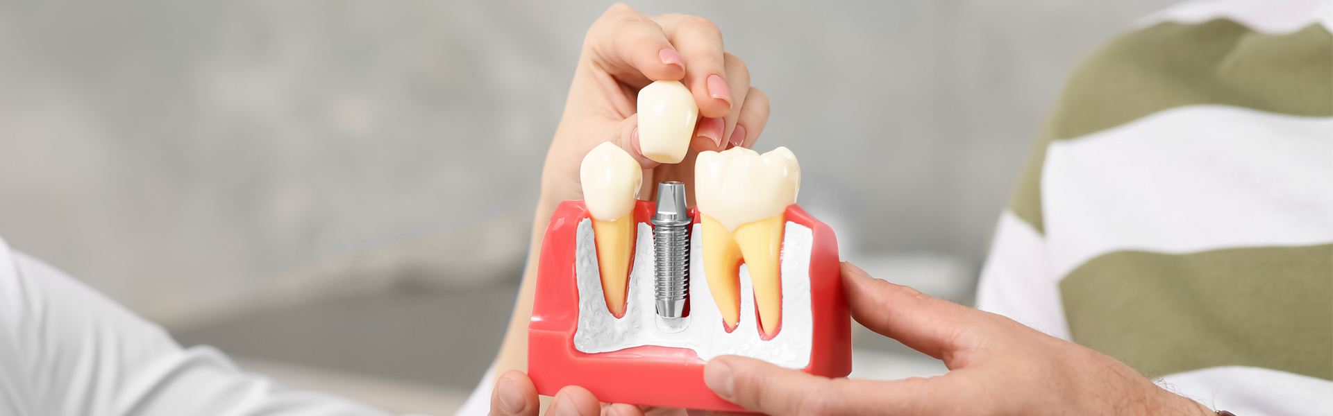 Bone Grafting for Dental Implants: Purpose and Procedure