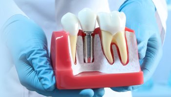 Preventing Dental Implant Complications: Tips for Success
