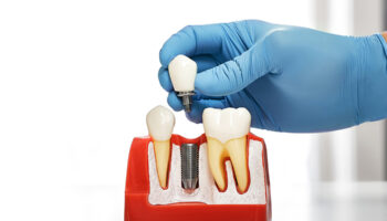 How Dental Implants Improve Chewing Power