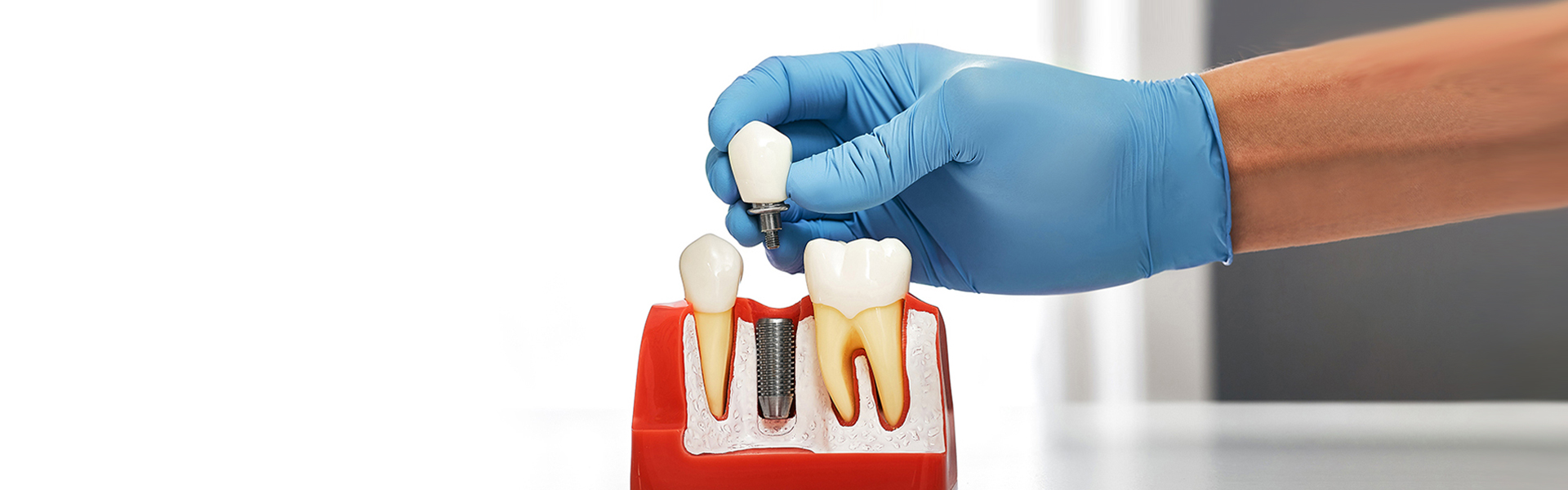How Dental Implants Improve Chewing Power