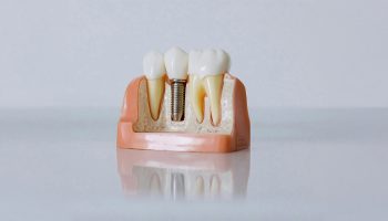 What Do Dental Implants Feel Like?