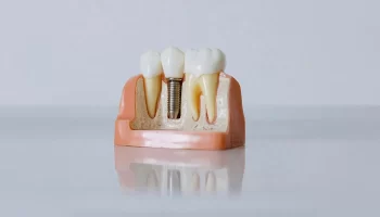 Dental Implants: The Complete 2026 Guide to Types, Steps, Pros and Cons